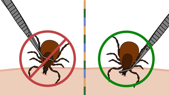 3 Steps to Removing Ticks Safely Putting the Pieces Together